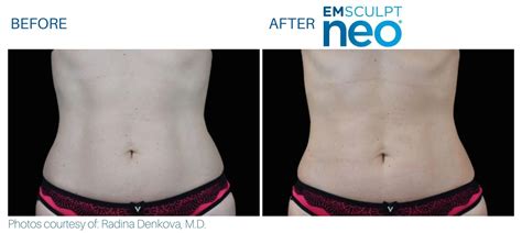 emsculpt neo in maryland.
